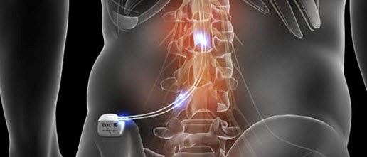 HF-10 Spinal Cord Stimulation for Pain